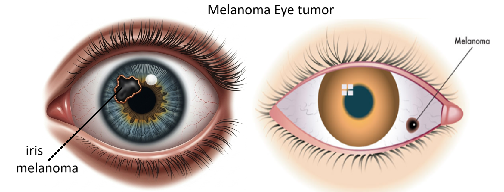 Ocular Melanoma Treatment in India